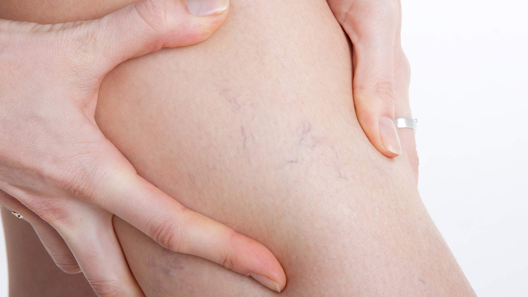 Read more about the article All you need to know: Varicose veins