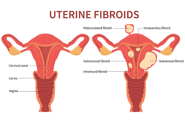 can fibroid cause you to gain weight
