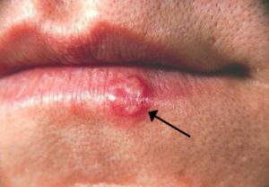 Read more about the article How to cure herpes naturally forever